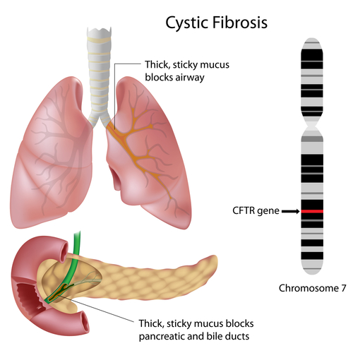 Ảnh 2 của Cystic fibrosis